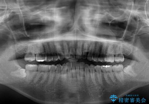 唇が閉じにくい ワイヤー装置での抜歯矯正の治療前