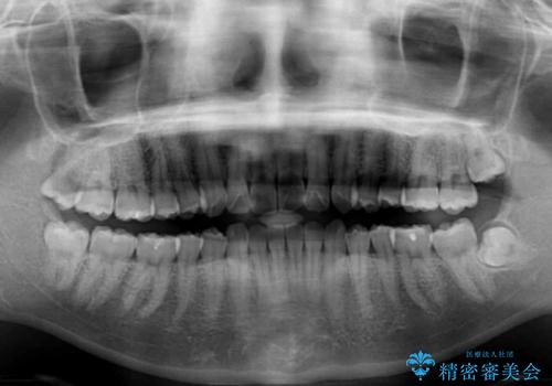 インビザライン矯正で前歯のデコボコを改善の治療前