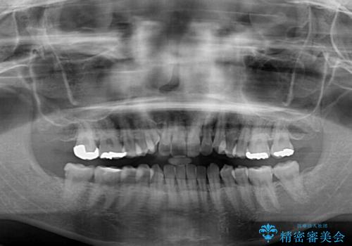 気になる八重歯 ワイヤー装置での非抜歯矯正の治療前