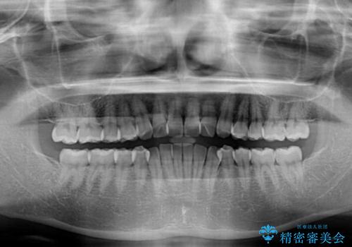 上下前歯のデコボコ ワイヤー装置で楽して改善の治療前