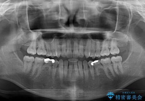 すきっ歯をインビザラインできれいな歯並びに改善の治療前