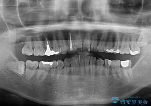 ハーフリンガルで歯列をきれいに セラミック治療で気になる銀歯も自然な色にの治療前