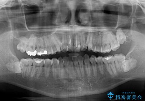 デコボコと変色した前歯 抜歯矯正と審美歯科治療の治療前