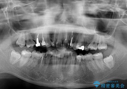 歯列から飛び出た歯　ワイヤー矯正で整った歯列にの治療前