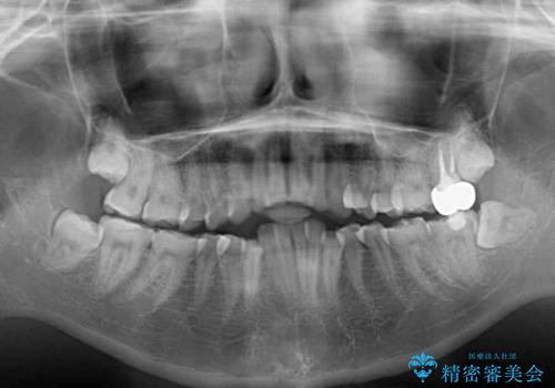 酸蝕歯でボロボロの歯の審美歯科治療 矯正治療も併用して、美しい口元への治療前