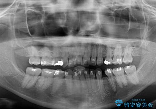 治療途中で帰国 装置をつけた状態を継続して矯正治療の治療前