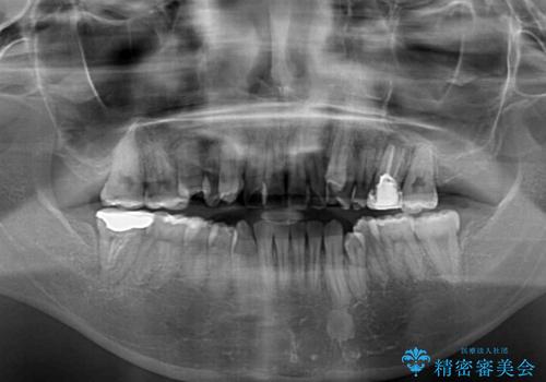 八重歯と開咬の抜歯矯正 ワイヤー装置を併用したインビザライン矯正治療の治療前