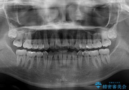 咬み合わせの乱れを改善 ワイヤー装置で楽々矯正治療の治療後