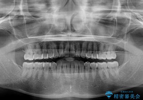上下前歯のデコボコ ワイヤー装置で楽して改善の治療後