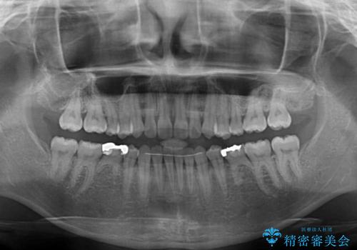 すきっ歯をインビザラインできれいな歯並びに改善の治療後