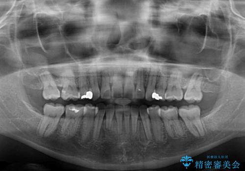 治療途中で帰国 装置をつけた状態を継続して矯正治療の治療後