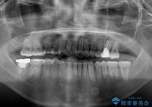 八重歯と開咬の抜歯矯正 ワイヤー装置を併用したインビザライン矯正治療の治療後