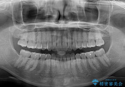 インビザライン矯正で前歯のデコボコを改善の治療後