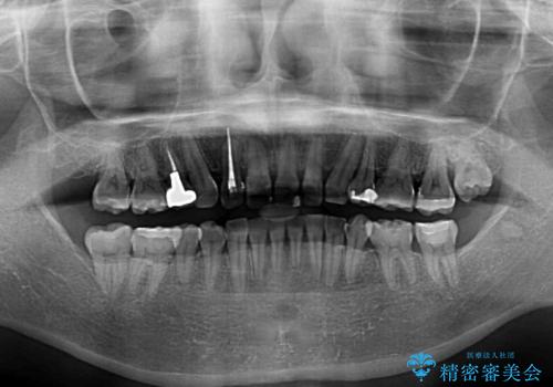 ハーフリンガルで歯列をきれいに セラミック治療で気になる銀歯も自然な色にの治療後