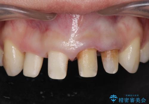 変色した歯を改善、セラミック治療の治療中