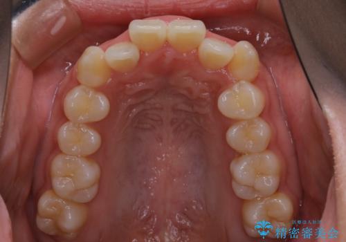 インビザライン矯正 短期間でがたつきのない歯並びに!の治療前
