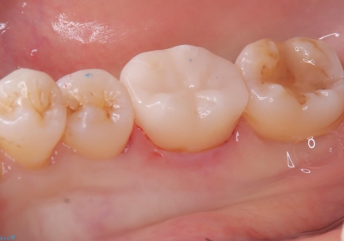 【セラミックインレー】歯と歯の間に物がよく詰まるの治療後