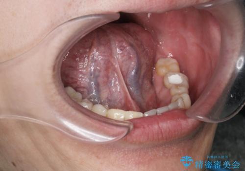 [ 舌小帯の形成術 ]  短い舌の改善をしたいの治療前