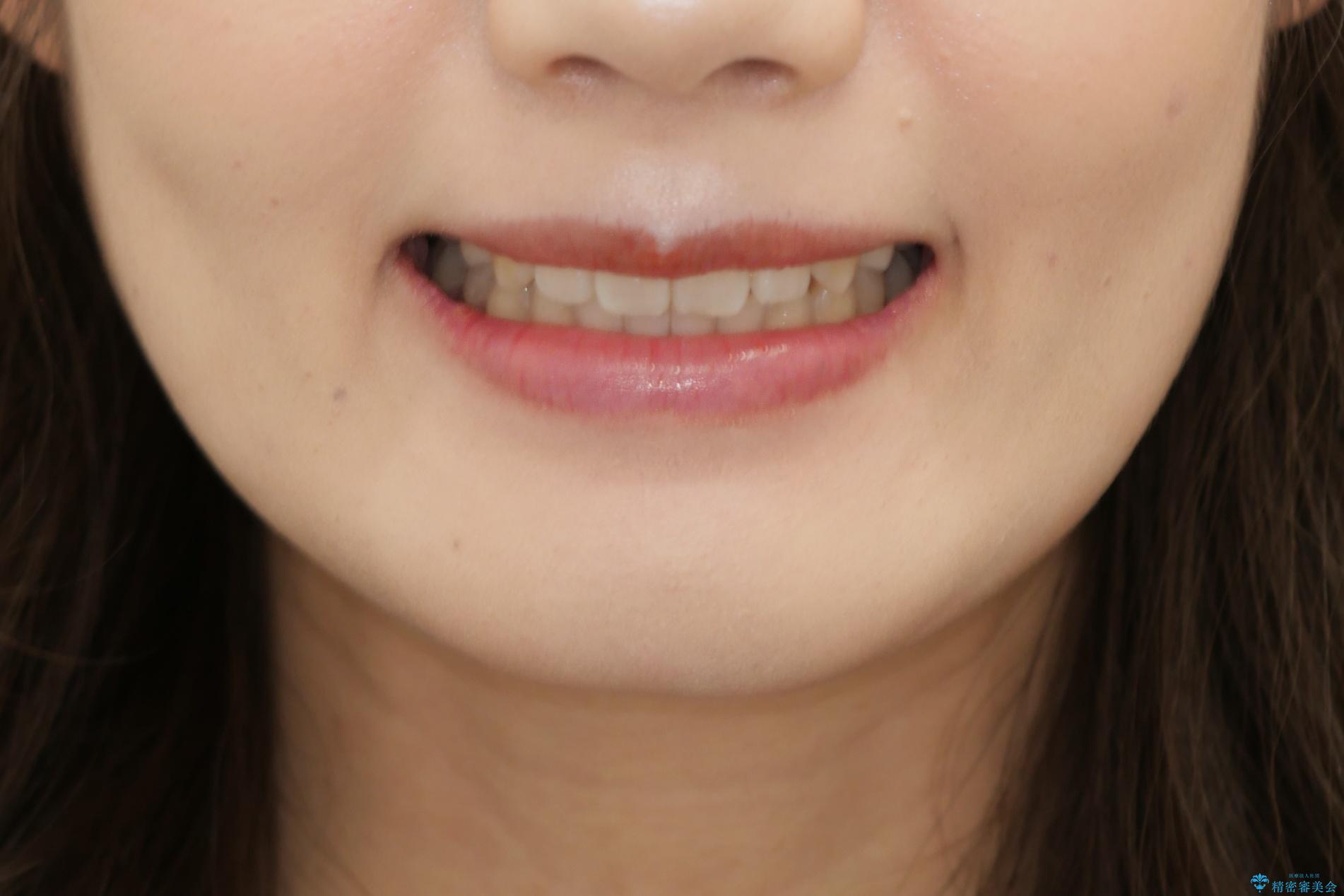 ワイヤー矯正　抜歯本数を最小限にし、八重歯のない歯並びに　の治療後（顔貌）