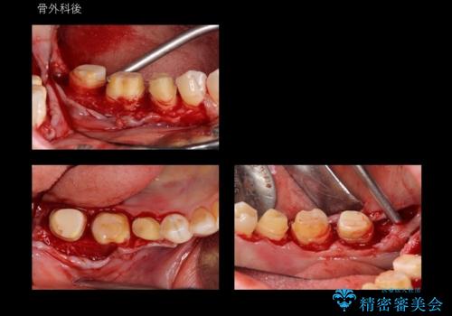 奥歯の高さがない 歯周外科で解決の治療中