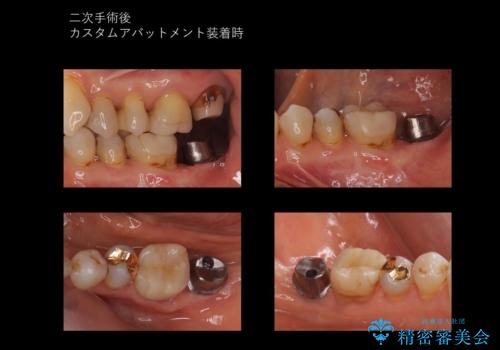 奥歯のインプラント 永くもつようにの治療中