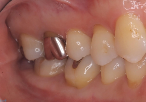 【セラミックインレー】歯と歯の間に物がよく詰まるの治療前