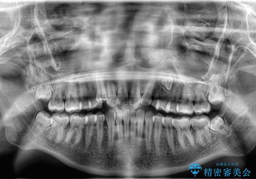 【埋伏歯】犬歯の牽引を行った矯正歯科治療の治療前