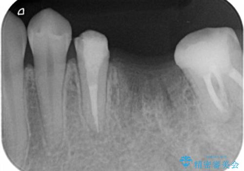 奥歯の高さがない　20代で入れ歯もインプラントも難しい　ブリッジで歯を残す治療の治療中