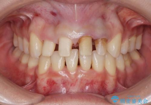 変色した歯を改善、セラミック治療の治療中
