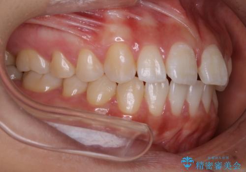 インビザライン矯正 前歯のすきっ歯を治したいの治療前