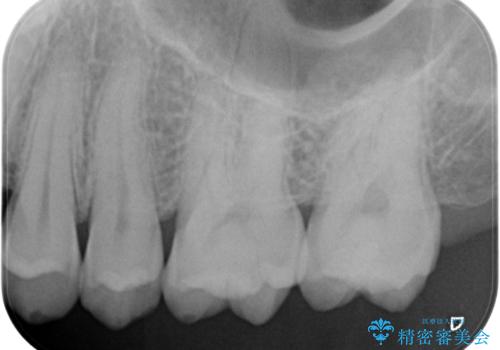奥歯の虫歯　セラミックインレーでの修復処置の治療後