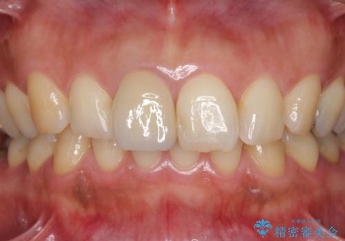 折れてしまった前歯   オールセラミックによる審美改善の治療後