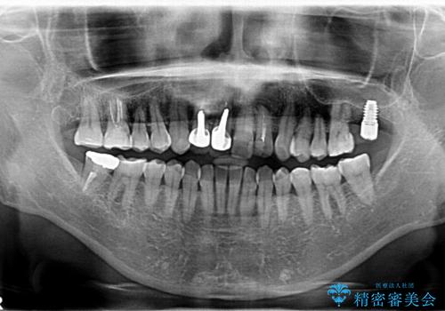 全体的な虫歯治療 他院で入れたインプラントの続きもの治療前
