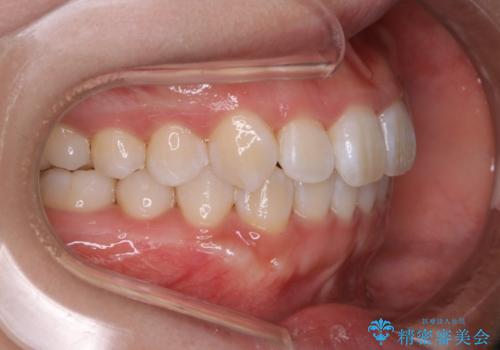 インビザライン矯正 短期間でがたつきのない歯並びに!の治療後