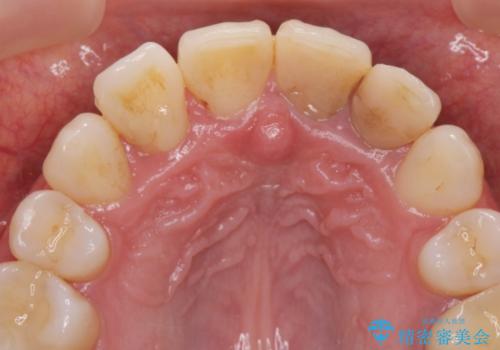 変色した歯を改善、セラミック治療の治療前