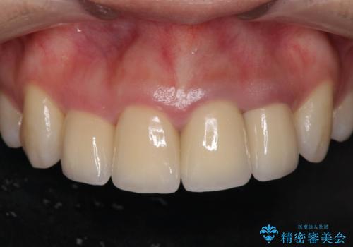 変色した歯を改善、セラミック治療の治療後