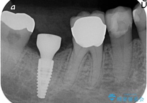 60代女性 奥歯のインプラント の治療中