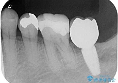奥歯のインプラント 永くもつようにの治療後
