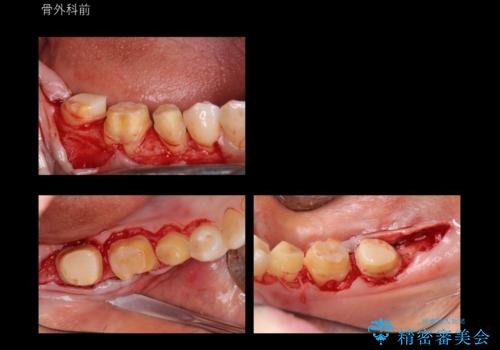 奥歯の高さがない 歯周外科で解決の治療中