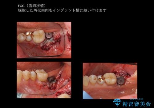 奥歯のインプラント 永くもつようにの治療中