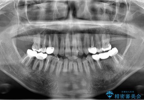 全体的な虫歯治療の治療後