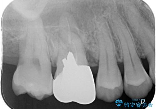 歯がしみる セラミックインレーで改善の治療前