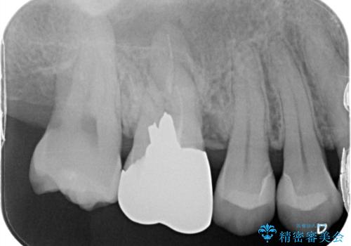 歯がしみる セラミックインレーで改善の治療後