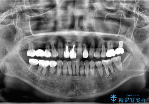 全体的な虫歯治療 他院で入れたインプラントの続きもの治療後