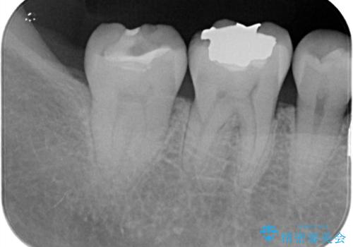 歯と歯の間に物がよく詰まるの治療前