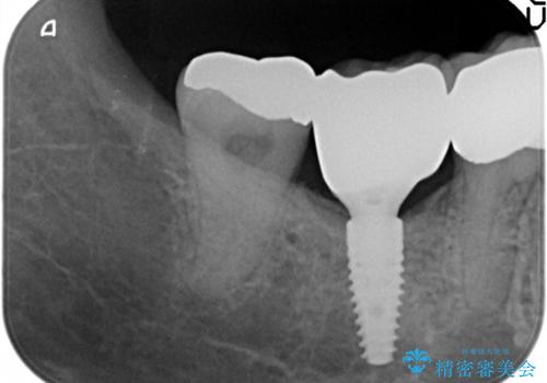 60代女性 奥歯のインプラント の治療後
