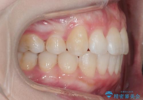 ワイヤー矯正　抜歯本数を最小限にし、八重歯のない歯並びに　の治療後