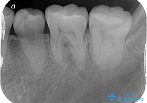 昔治した歯の形が気になる セラミックインレーでキレイな歯に!の治療後