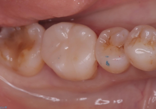 歯と歯の間に物がよく詰まるの治療後