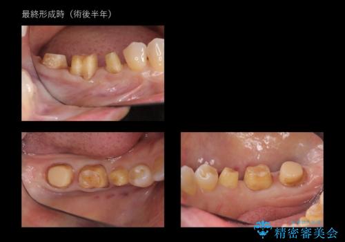 奥歯の高さがない 歯周外科で解決の治療中